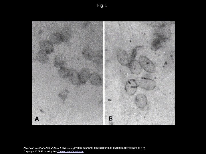 Fig. 5 American Journal of Obstetrics & Gynecology 1996 1751543 -1550 DOI: (10. 1016/S