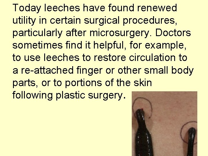Today leeches have found renewed utility in certain surgical procedures, particularly after microsurgery. Doctors