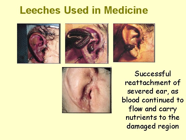 Leeches Used in Medicine Successful reattachment of severed ear, as blood continued to flow