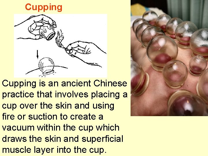 Cupping is an ancient Chinese practice that involves placing a cup over the skin