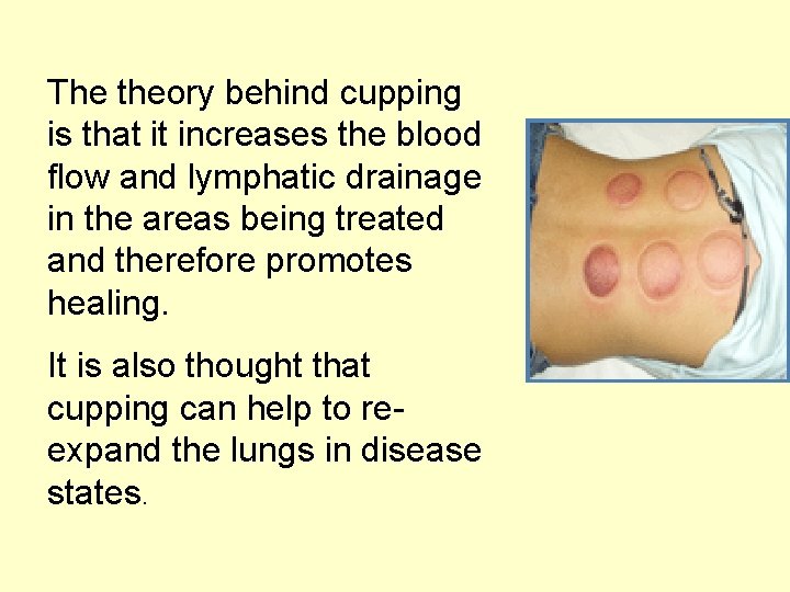 The theory behind cupping is that it increases the blood flow and lymphatic drainage