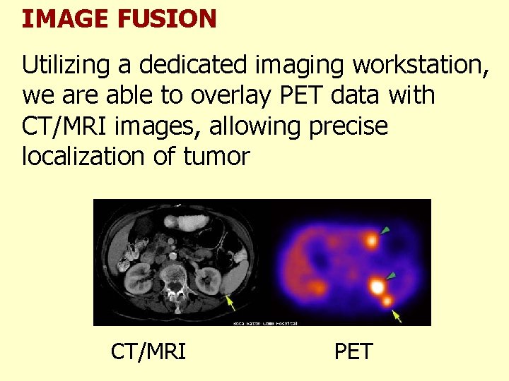 IMAGE FUSION Utilizing a dedicated imaging workstation, we are able to overlay PET data