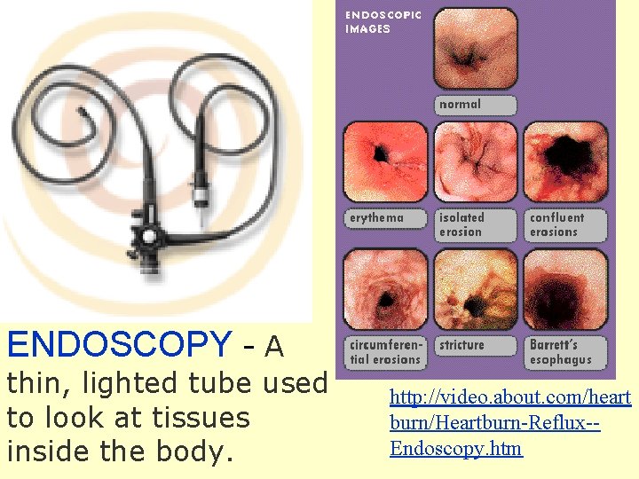ENDOSCOPY - A thin, lighted tube used to look at tissues inside the body.