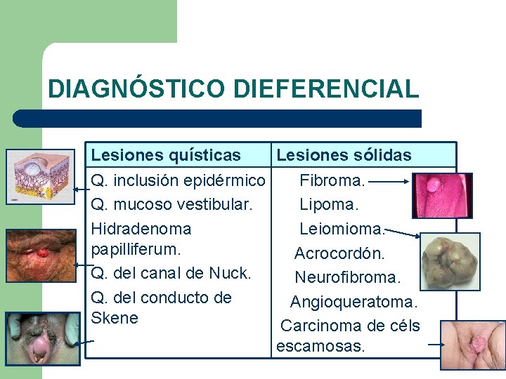 DIAGNÓSTICO DIEFERENCIAL Lesiones quísticas Lesiones sólidas Q. inclusión epidérmico Fibroma. Q. mucoso vestibular. Lipoma.