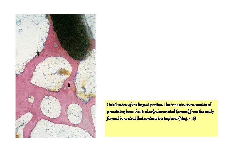 Detail review of the lingual portion. The bone structure consists of preexisting bone that