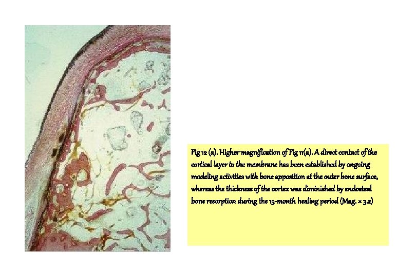 Fig 12 (a). Higher magnification of Fig 11(a). A direct contact of the cortical