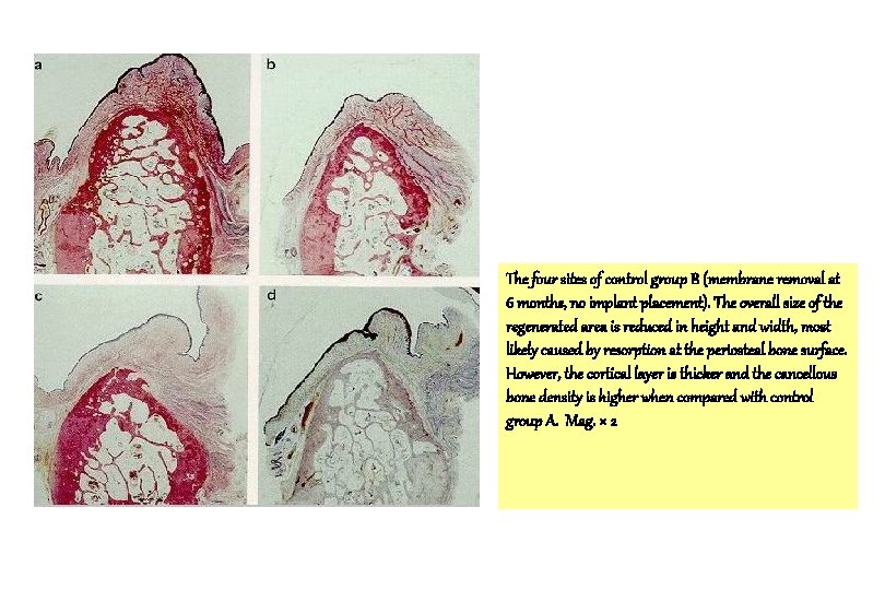 The four sites of control group B (membrane removal at 6 months, no implant