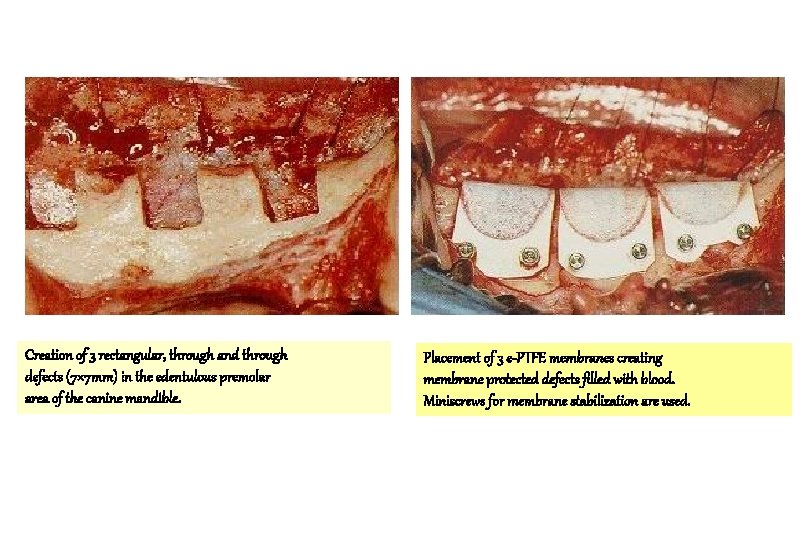 Creation of 3 rectangular, through and through defects (7× 7 mm) in the edentulous