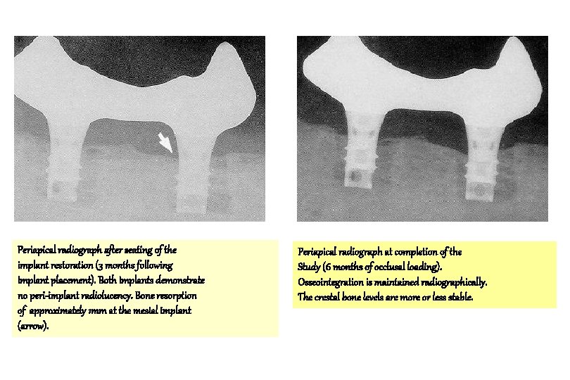 Periapical radiograph after seating of the implant restoration (3 months following implant placement). Both