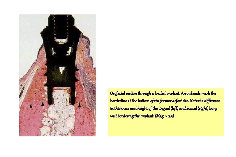 Orofacial section through a loaded implant. Arrowheads mark the borderline at the bottom of