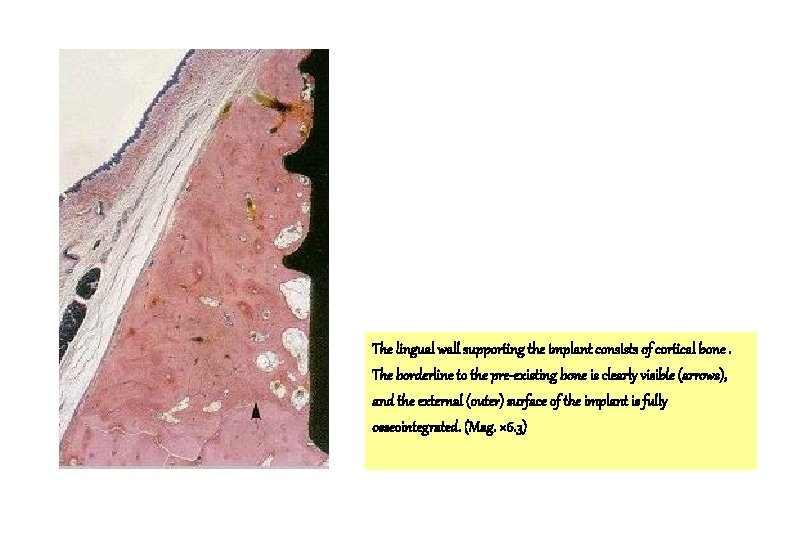 The lingual wall supporting the implant consists of cortical bone. The borderline to the