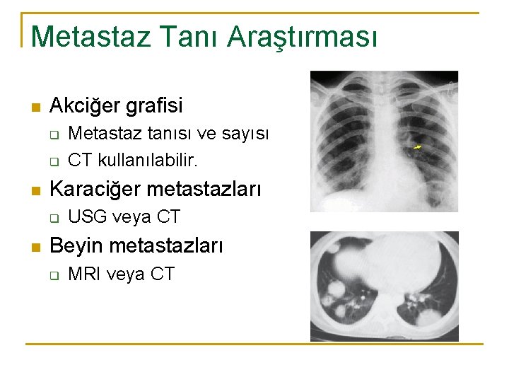 Metastaz Tanı Araştırması n Akciğer grafisi q q n Karaciğer metastazları q n Metastaz