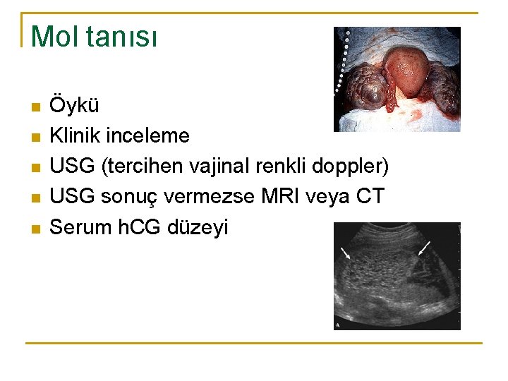 Mol tanısı n n n Öykü Klinik inceleme USG (tercihen vajinal renkli doppler) USG