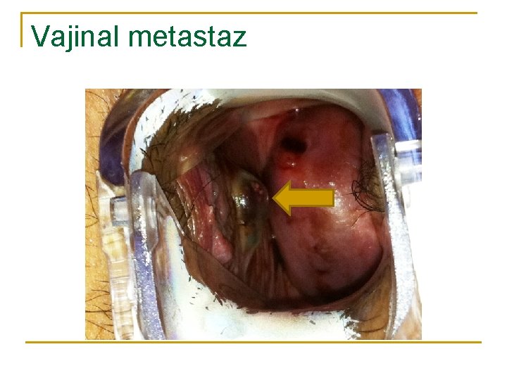 Vajinal metastaz 