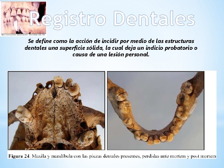 Registro Dentales Se define como la acción de incidir por medio de las estructuras