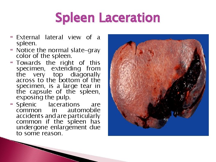 Spleen Laceration External lateral view of a spleen. Notice the normal slate-gray color of