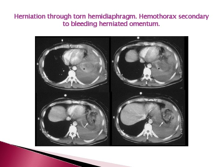 Herniation through torn hemidiaphragm. Hemothorax secondary to bleeding herniated omentum. 