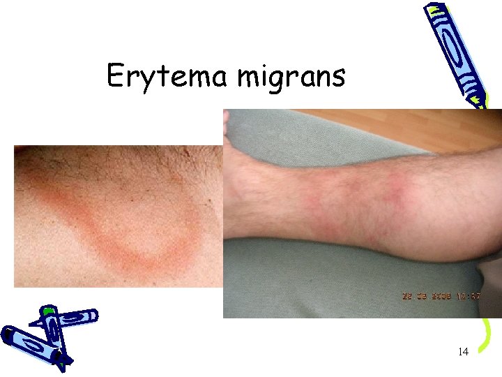 Erytema migrans 14 