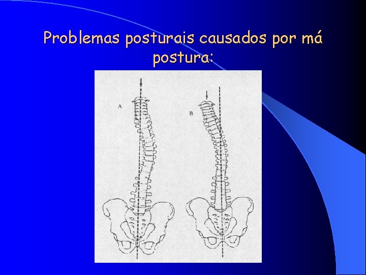 Problemas posturais causados por má postura: 