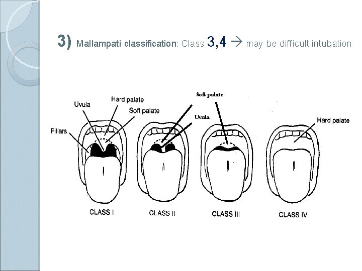 3) Mallampati classification: Class 3, 4 may be difficult intubation Soft palate Uvula 
