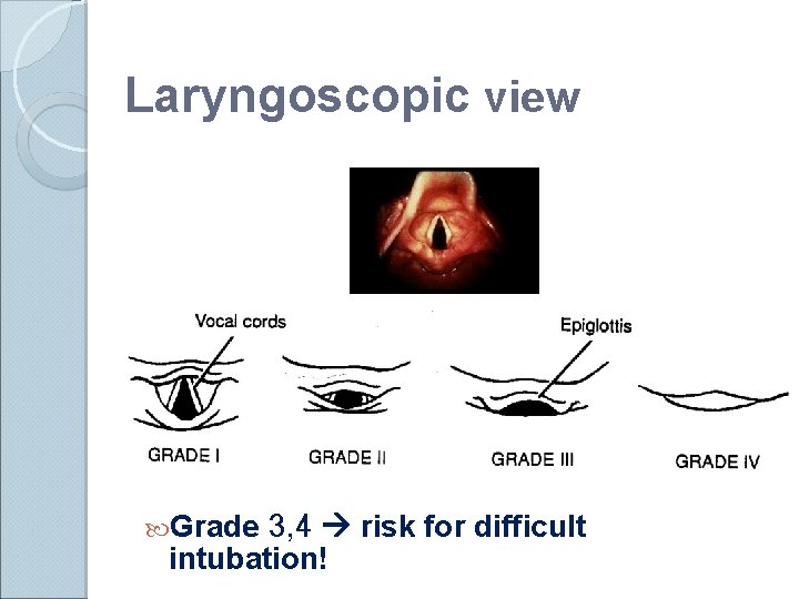 Laryngoscopic view Grade 3, 4 risk for difficult intubation! 