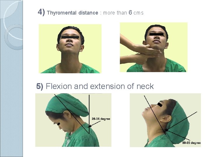 4) Thyromental distance : more than 6 cms 5) Flexion and extension of neck