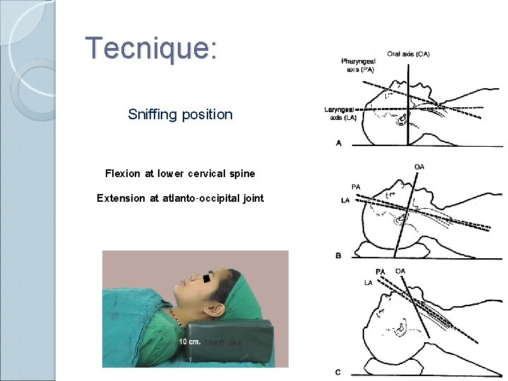 Tecnique: Sniffing position Flexion at lower cervical spine Extension at atlanto-occipital joint 