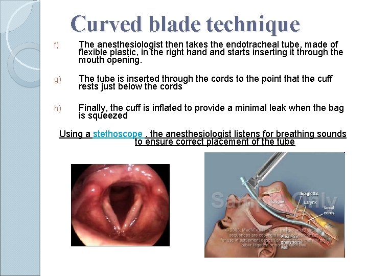 Curved blade technique f) The anesthesiologist then takes the endotracheal tube, made of flexible