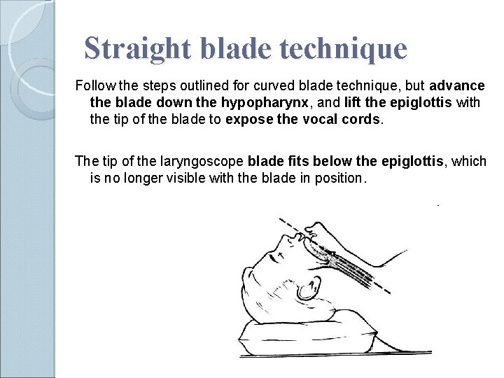 Straight blade technique Follow the steps outlined for curved blade technique, but advance the