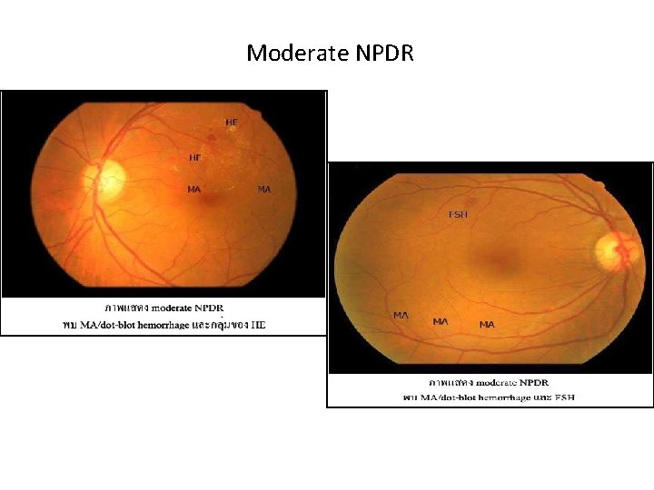 Moderate NPDR 