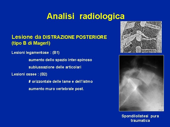 Analisi radiologica Lesione da DISTRAZIONE POSTERIORE (tipo B di Magerl) Lesioni legamentose : (B