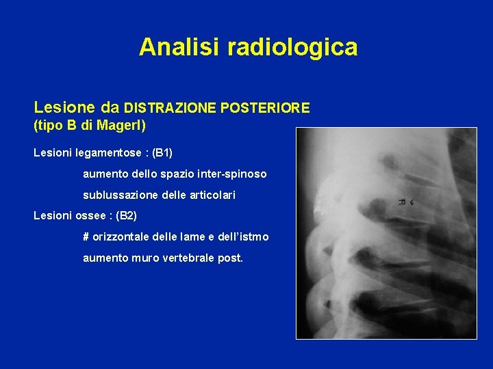Analisi radiologica Lesione da DISTRAZIONE POSTERIORE (tipo B di Magerl) Lesioni legamentose : (B