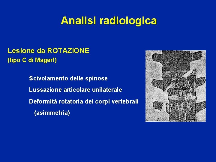 Analisi radiologica Lesione da ROTAZIONE (tipo C di Magerl) Scivolamento delle spinose Lussazione articolare