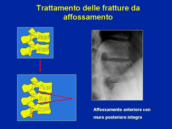 Trattamento delle fratture da affossamento Affossamento anteriore con muro posteriore integro 