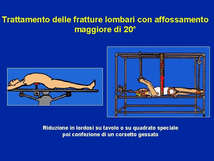 Trattamento delle fratture lombari con affossamento maggiore di 20° Riduzione in lordosi su tavolo