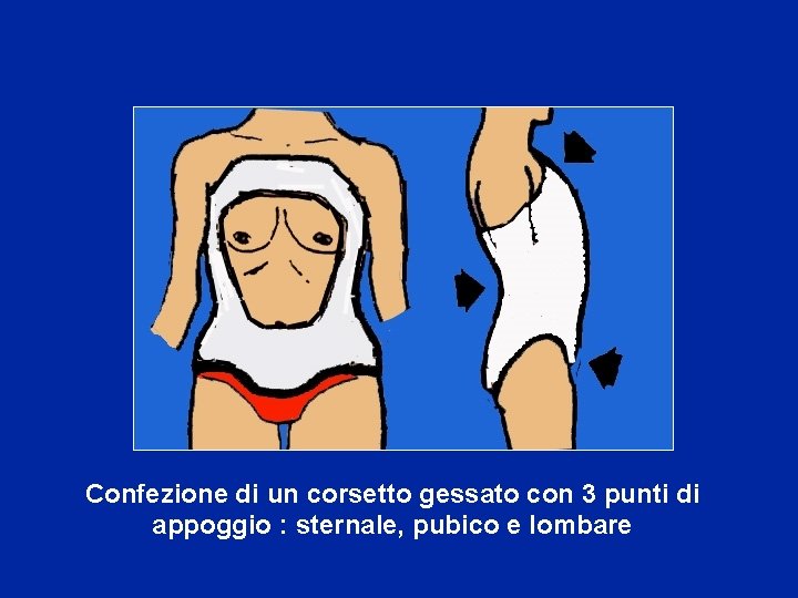 Confezione di un corsetto gessato con 3 punti di appoggio : sternale, pubico e