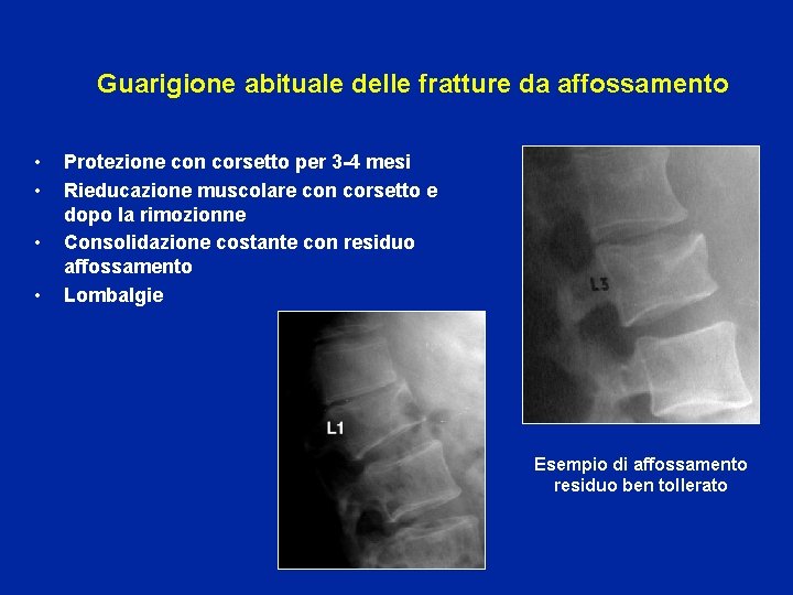 Guarigione abituale delle fratture da affossamento • • Protezione con corsetto per 3 -4