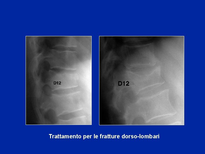 Trattamento per le fratture dorso-lombari 