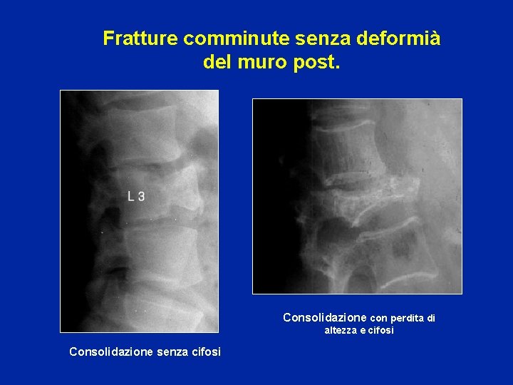 Fratture comminute senza deformià del muro post. Consolidazione con perdita di altezza e cifosi