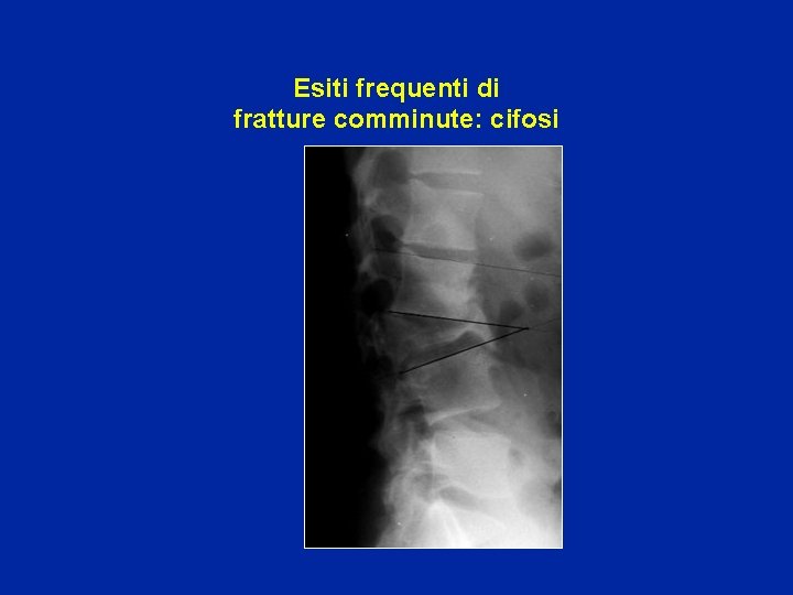 Esiti frequenti di fratture comminute: cifosi 