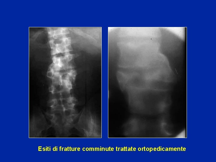 Esiti di fratture comminute trattate ortopedicamente 
