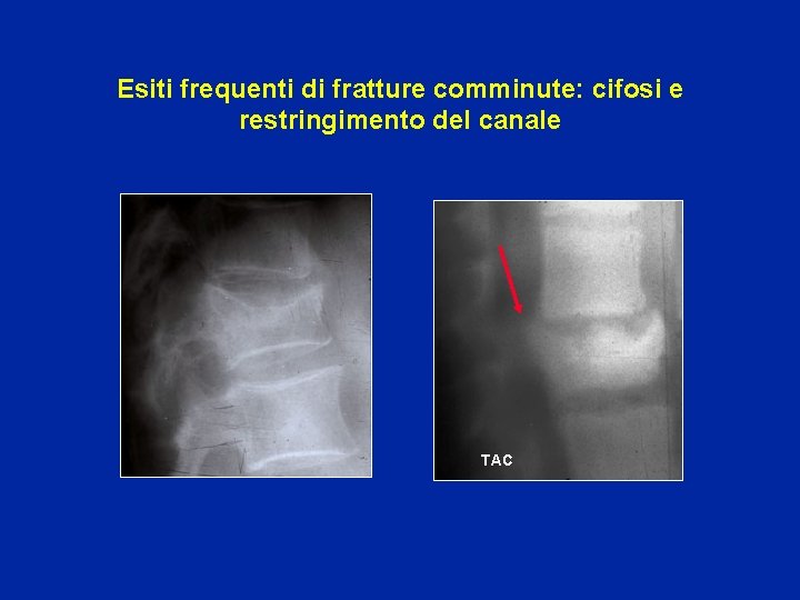 Esiti frequenti di fratture comminute: cifosi e restringimento del canale TAC 