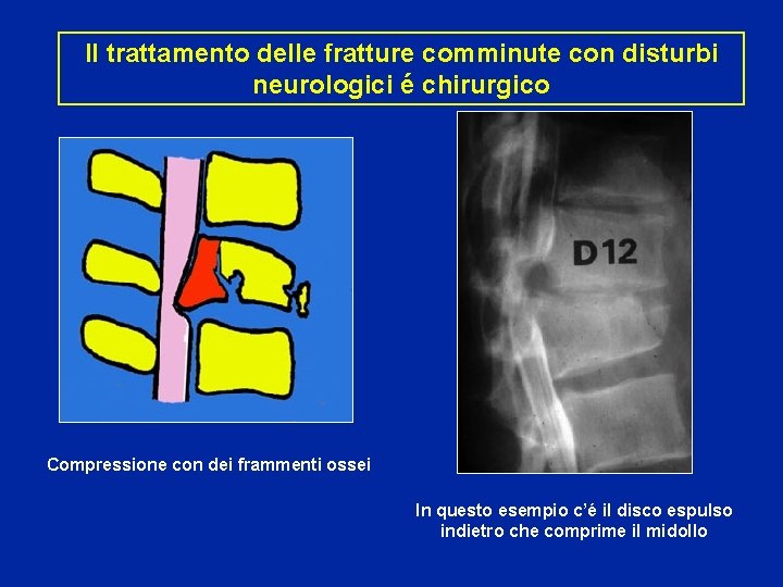 Il trattamento delle fratture comminute con disturbi neurologici é chirurgico Compressione con dei frammenti