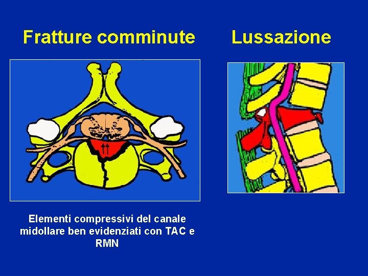 Fratture comminute Lussazione Elementi compressivi del canale midollare ben evidenziati con TAC e RMN