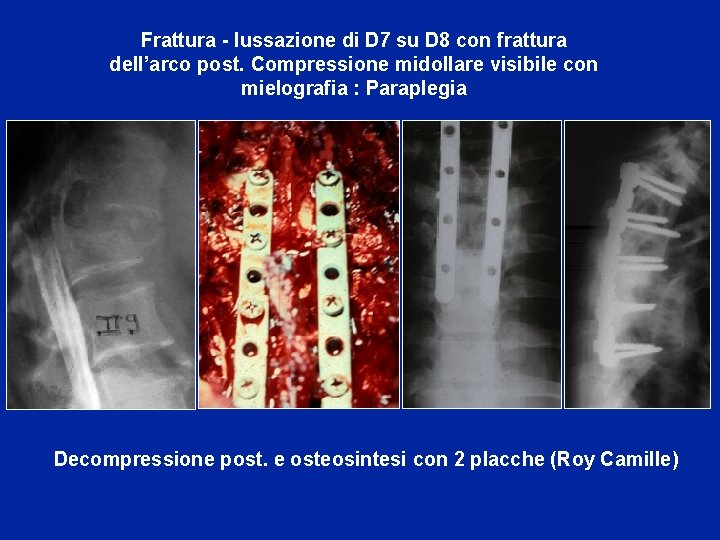 Frattura - lussazione di D 7 su D 8 con frattura dell’arco post. Compressione