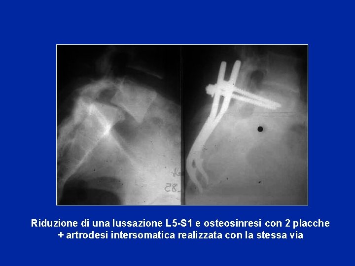 Riduzione di una lussazione L 5 -S 1 e osteosinresi con 2 placche +