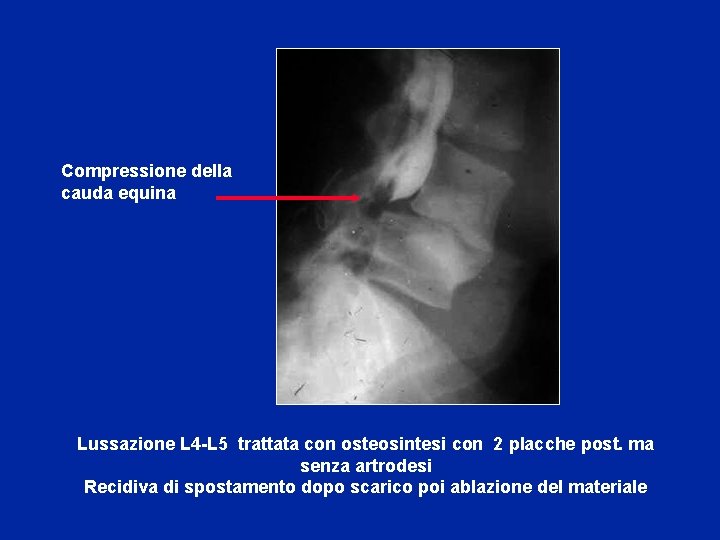 Compressione della cauda equina Lussazione L 4 -L 5 trattata con osteosintesi con 2