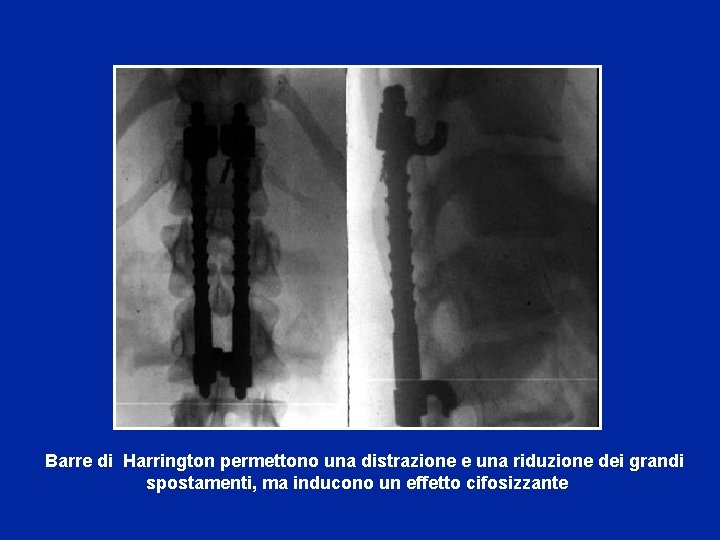  Barre di Harrington permettono una distrazione e una riduzione dei grandi spostamenti, ma