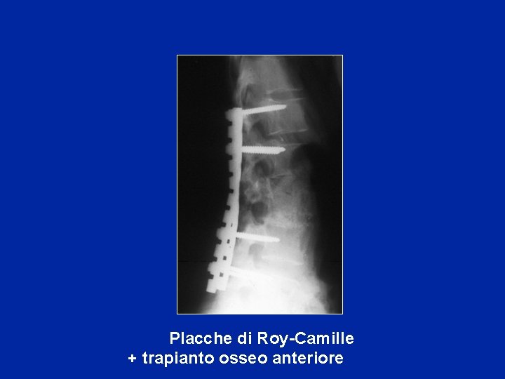  Placche di Roy-Camille + trapianto osseo anteriore 