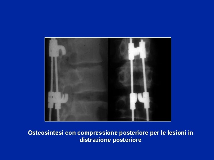 Osteosintesi con compressione posteriore per le lesioni in distrazione posteriore 